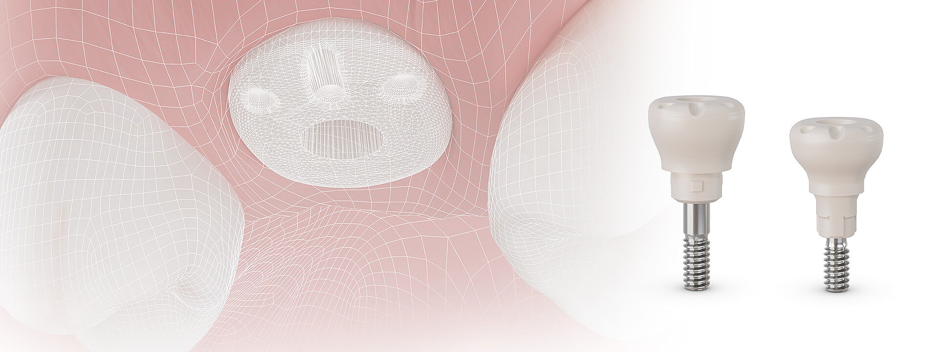 PEEK healing cap placed in a jaw model with occlusal scan marking and buccal marking. On the right side two standing healing caps showing the natural emergence profiles.
