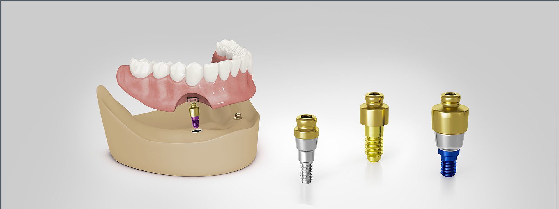 Cette image montre un modèle dentaire en arrière-plan illustrant l'utilisation d'implants dentaires et du système ODSecure pour la fixation sécurisée de prothèses dentaires amovibles. La partie supérieure montre un ensemble de dents artificielles au-dessus d'une base de prothèse dentaire. Entre les deux se trouve l'implant surmonté du pilier ODSecure.