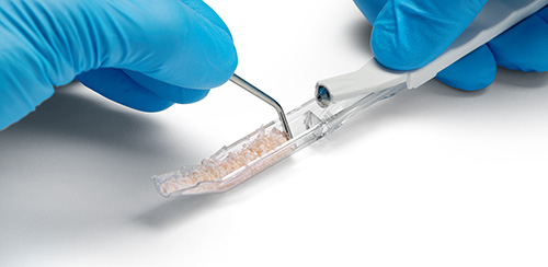 Bone Scraper Anwendung: Entnahme der Knochenspäne Bone Scraper Anwendung: Die transparente Kammer des Knochenschabers laesst sich mit Fingerdruck nach vorne oeffnen, und die Knochenspaene lassen sich mit einem Instrument entnehmen.