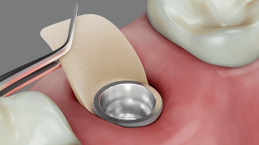 Épaississement des tissus autour des implants et des dents avec la technique de la poche.