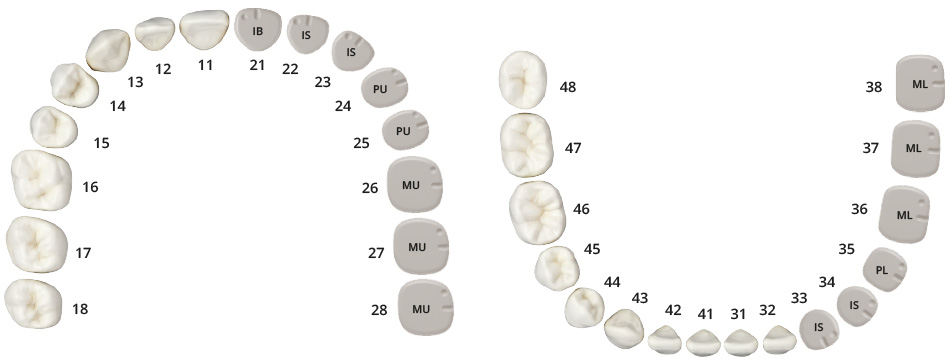 Six anatomically predefined tooth shapes and toothshaped PEEK healing caps aligned on one upper jaw and one lower jaw.