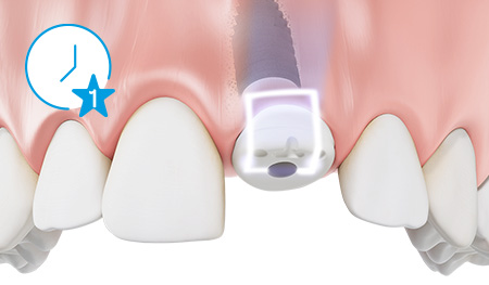 PEEK healing cap screw-retained on the implant with occlusal scan marking and buccal marking. Blue clock icon with star and number one in the upper left hand corner of the image indicating time saving benefits inbetween step one and step two.